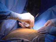 Inside the Operating Room: Dr. Doolabh Performs Minimally-Invasive Aortic Valve Replacement