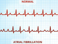 Surgical Innovations: Atrial Fibrillation & Heart Valve Disease