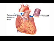 The Ross Procedure: Advantages for Select Patients with Aortic Valve Disease