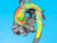 Research Alert: 4D Flow MRI for Aneurysm Detection in Bicuspid Aortic Valve Patients