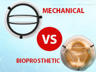 Mechanical vs. Bioprosthetic Heart Valve Replacements