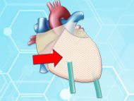 Medical Innovation: Can the CardiaMend Patch Stop Post-Op AFib?