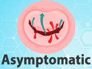 5 Facts: Asymptomatic Mitral Regurgitation
