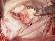 Operating Room Insights: The Different Faces of Mitral Valve Disease