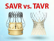 Patient Webinar: SAVR vs TAVR