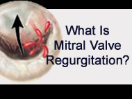 What Should You Know About Mitral Valve Regurgitation?