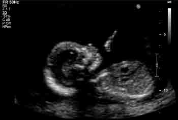 Ultrasound Pictures Of A Baby Girl
