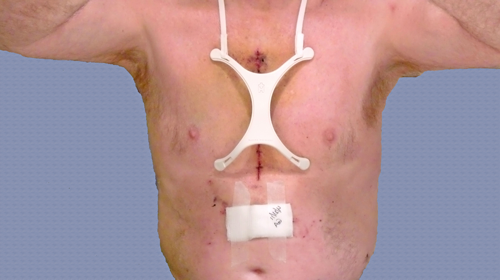 Incision Shield On Patient After Cardiac Surgery