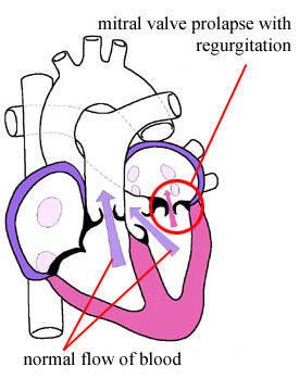 Mitral valve prolapse - Wikipedia, the.