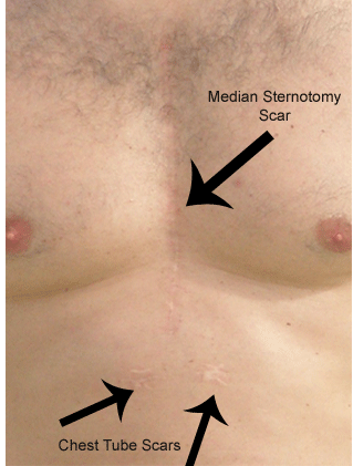 Incision Scar After Open Heart Surgery