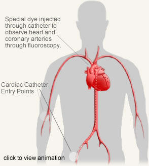 Angiogram Illustration, Diagram Of Angiography