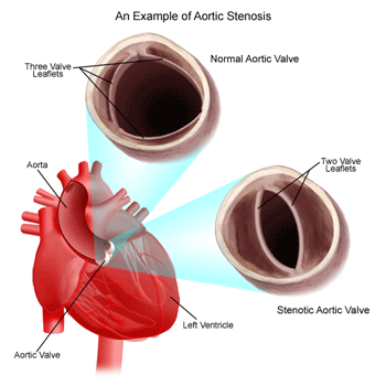 Aortic Stenosis Diagram - Bicuspid Heart Valve