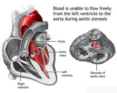 Valvular Image Of Aortic Stenosis Valve Disease