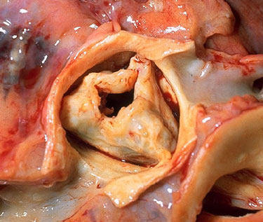 Heart Valve With Aortic Stenosis - Picture