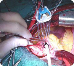 Aortic Valve Replacement Picture Using Bioprosthesis Valve Device