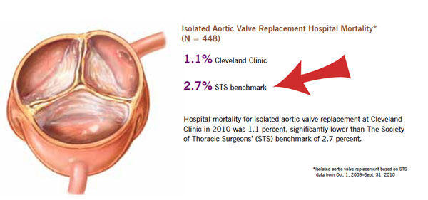 Aortic Valve Replacement Mortality Rate & Risks