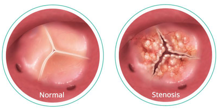 Normal and Stenosis
