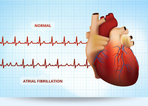 Image result for image of afib