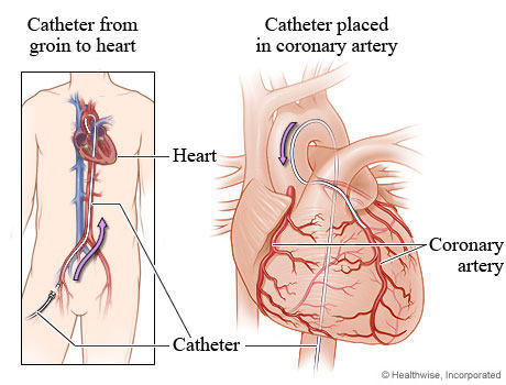 catheter