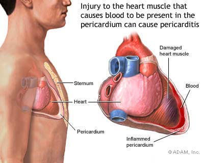 Heart attack pain in chest