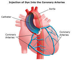 Heart Angiogram