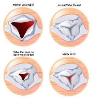 Heart Valve Leakage