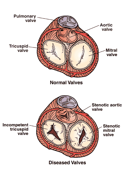 Heart Valve With Aortic Stenosis Valve. Dr. Paul Donohue writes back, 
