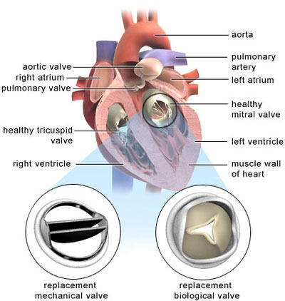 Heart Valve Replacement - Tissue and Mechanical Valve in Mitral Position