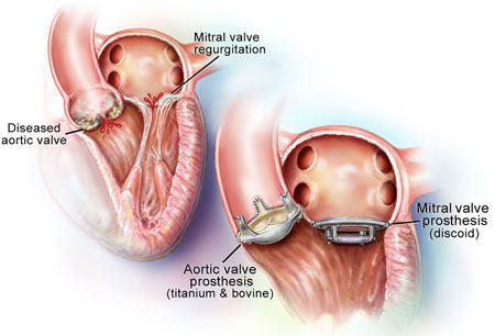 The picture also shows the two types of valve replacement devices that can 