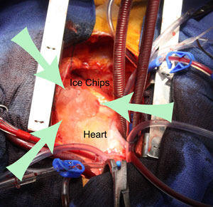 Ice Chips On Heart During Cardiac Surgery