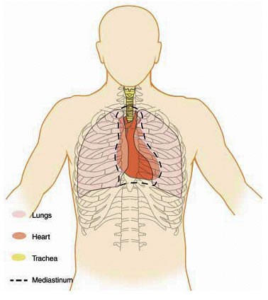 heart attack diagram. recently had heart valve