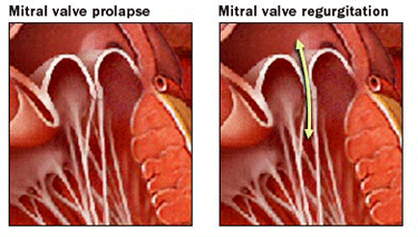 Mild Mitral Regurgitation