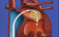 Percutaneous Mitral Valve Repair Clip Image Percutaneous Mitral Valve Repair Clip Image
