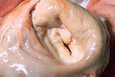 Narrow Heart Valve - Mitral Valve Stenosis