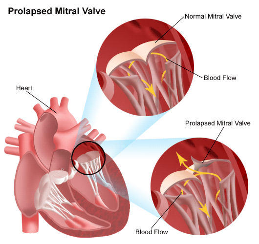  mitral valve regurgitation? My doctor said MVP is non-fatal. Is it true?