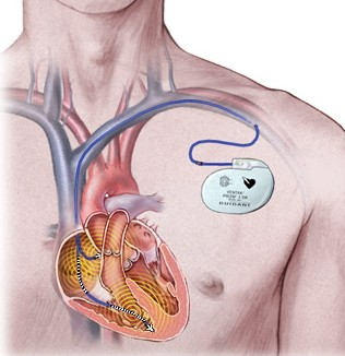 Drawing Of Pacemaker Implanted After Heart Valve Surgery