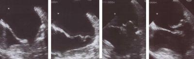PISA Mitral Regurgitation