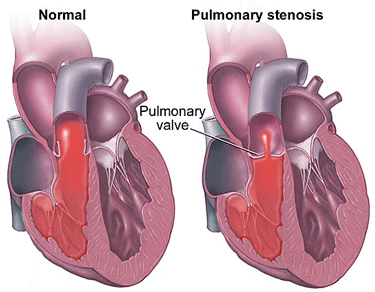 Pulmonary Stenosis - A Common Heart Valve Problem Pulmonary Stenosis - A Common Heart Valve Problem