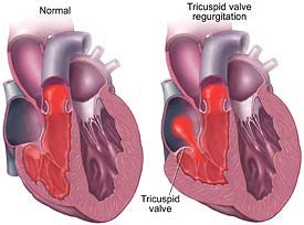 Tricuspid Regurgitation