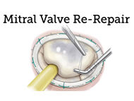 Mitral Valve Re-Repair: A 