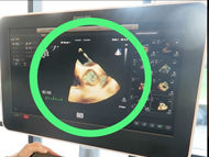 Using 3D Echocardiogram of Diseased Heart Valves to Advance Surgical Outcomes for Patients!