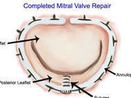 Surgeon Q&A: How Long Will My Annuloplasty Ring Last After Mitral Valve Repair Surgery?