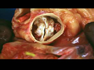 Can A Bicuspid Aortic Valve Be Repaired If An Aortic Aneurysm Is Present?