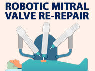 Doctor Q&A: Is Robotic Mitral Valve Re-Repair Possible?