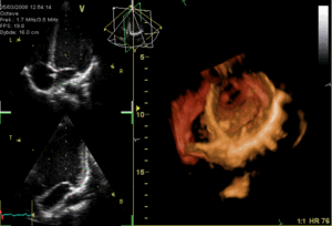 3D Image Of The Mitral Valve