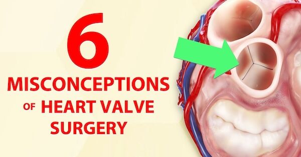 6 Misconceptions of Heart Valve Surgery