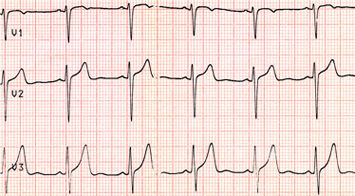Electrocardiogram Showing Atrial Fibrillation