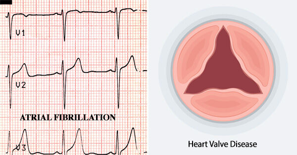 Atrial Fibrillation & Aortic Stenosis Diagram