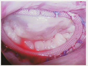 Patient Mitral Valve After Heart Valve Repair Surgery