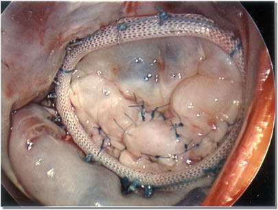 Tricuspid Valve Repair with Annuloplasty Ring